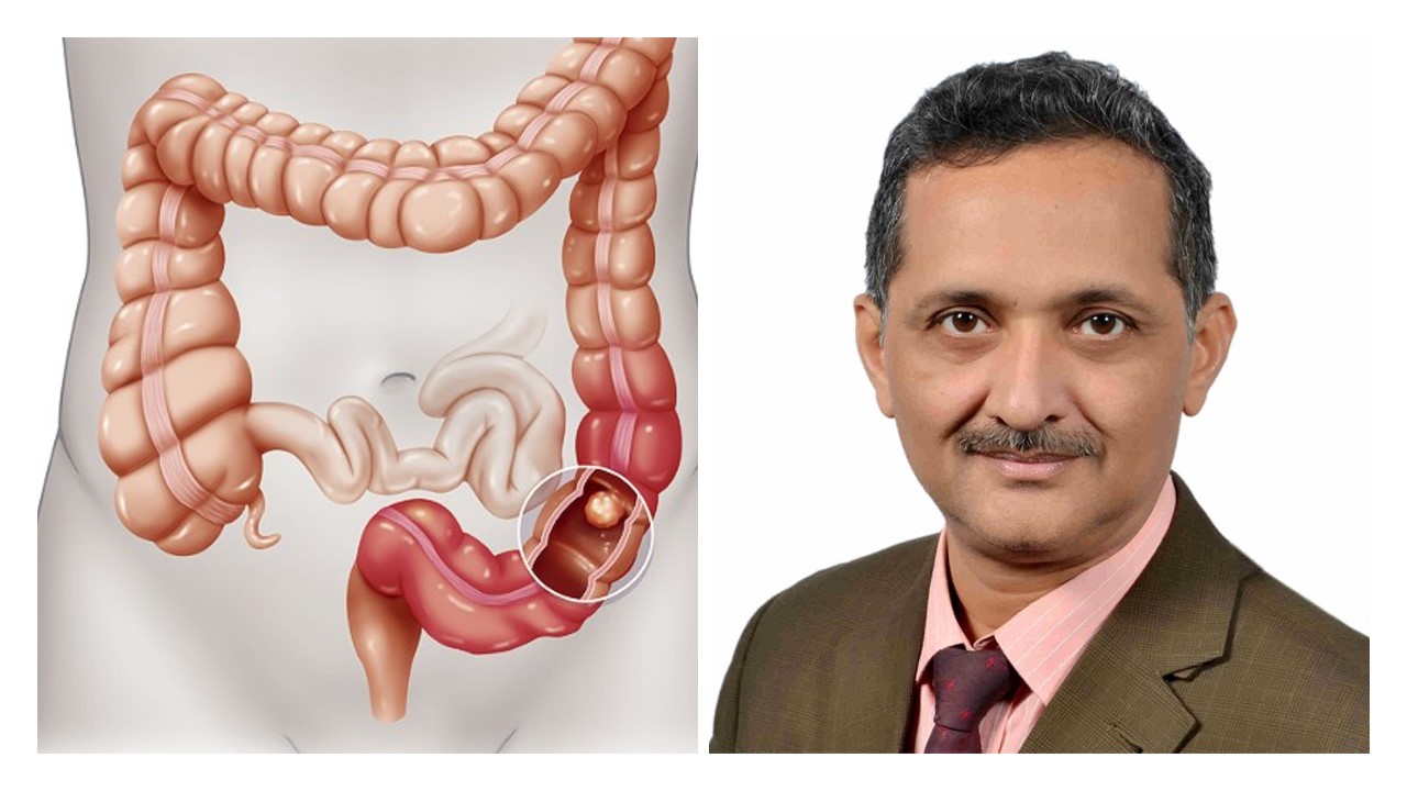 Colorectal Cancer In Rajasthan Colorectal Cancer In Rajasthan